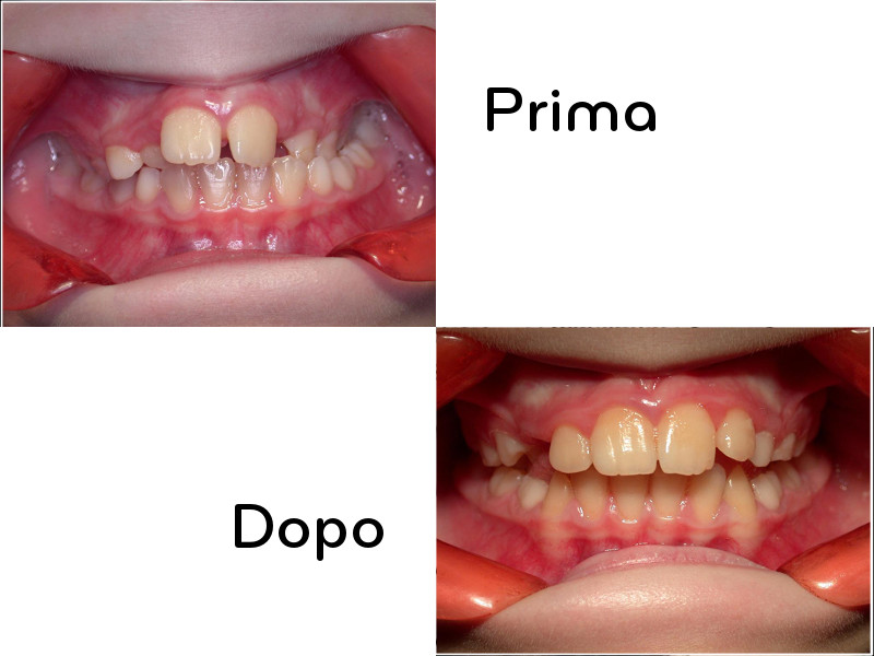 L’analisi delle aree di densità ossea mascellare e mandibolare nella diagnosi osteopatica delle malocclusioni