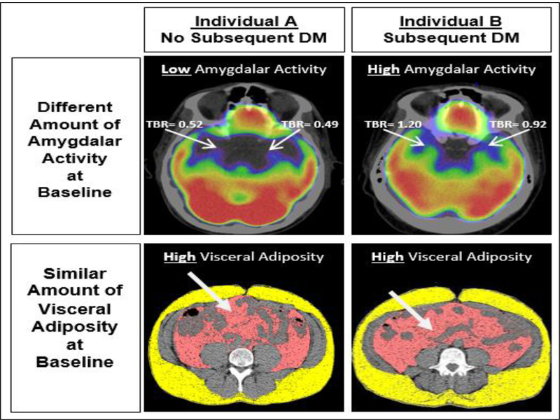 Emozioni e diabete: L’asse psiche-cervello-pancreas