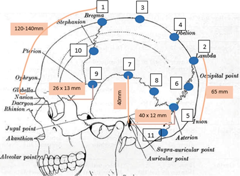 Emicrania, cefalea e suture craniche in ottica PNEI: perché usare terapie non farmacologiche come osteopatia e agopuntura